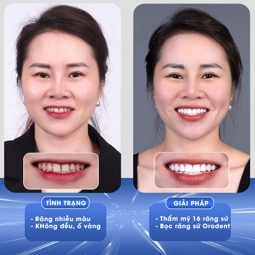 Bọc răng sứ Orodent