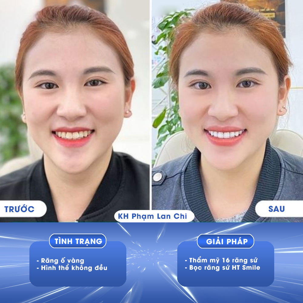 Răng sứ HT Smile